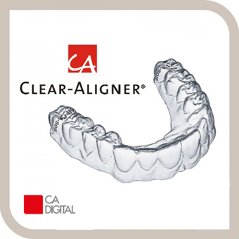 Clear Aligner