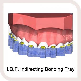 IBT Indirecting Bonding Tray